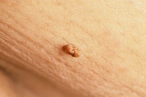 Skin Tags: Symptoms Causes and Treatment Options