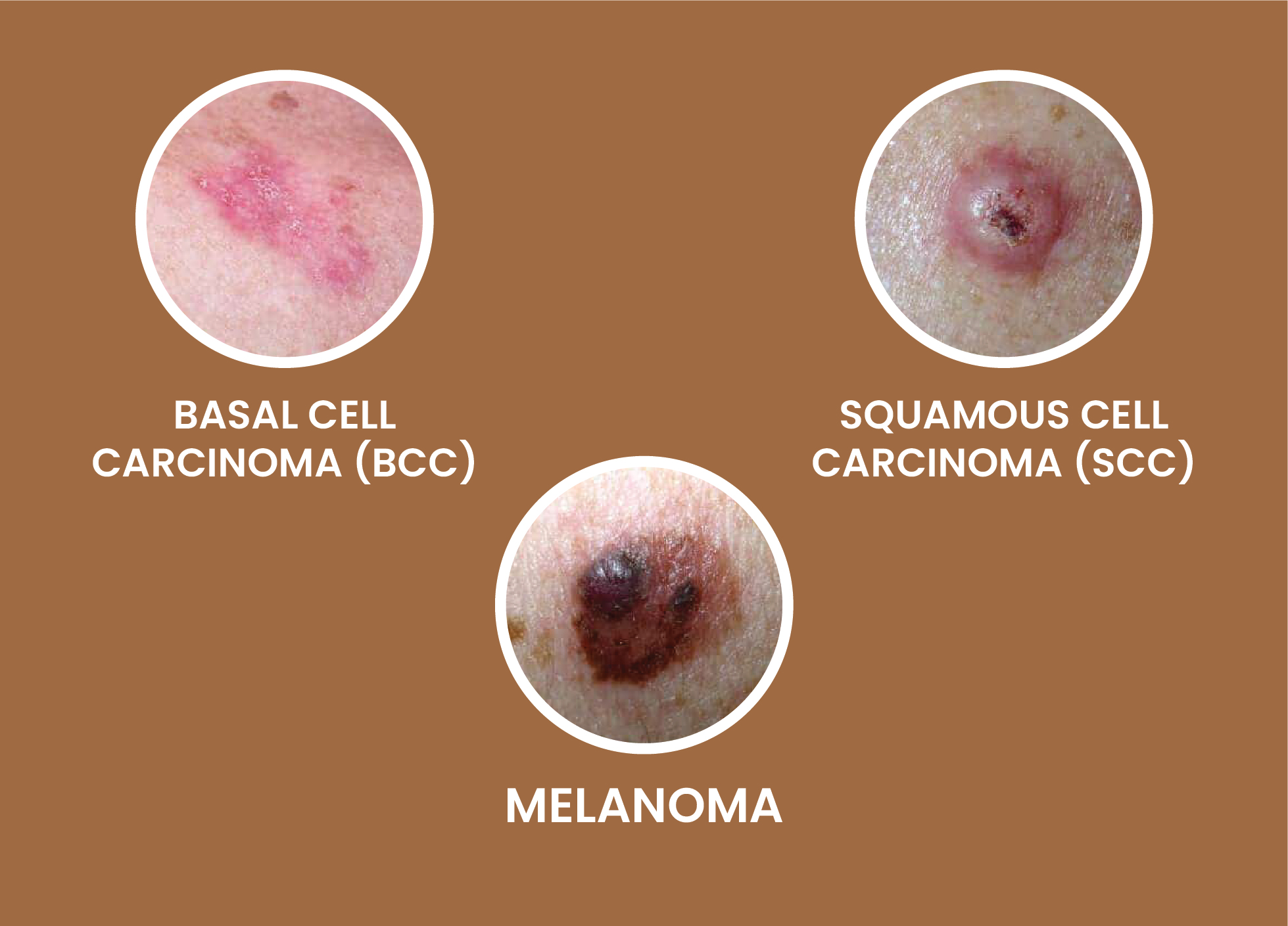 What Are The Different Types Of Skin Cancer Empowering You With